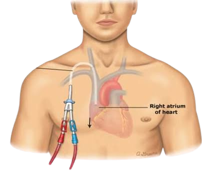 Catheter safety from infection during dialysis stage