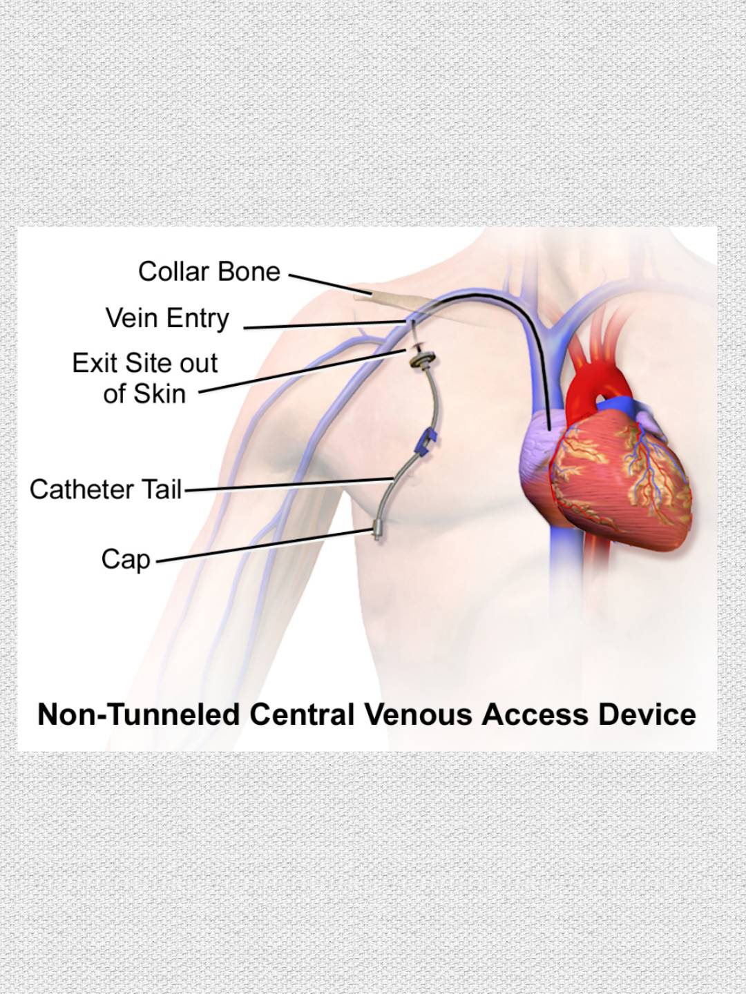 Catheter safety from infection during dialysis stage