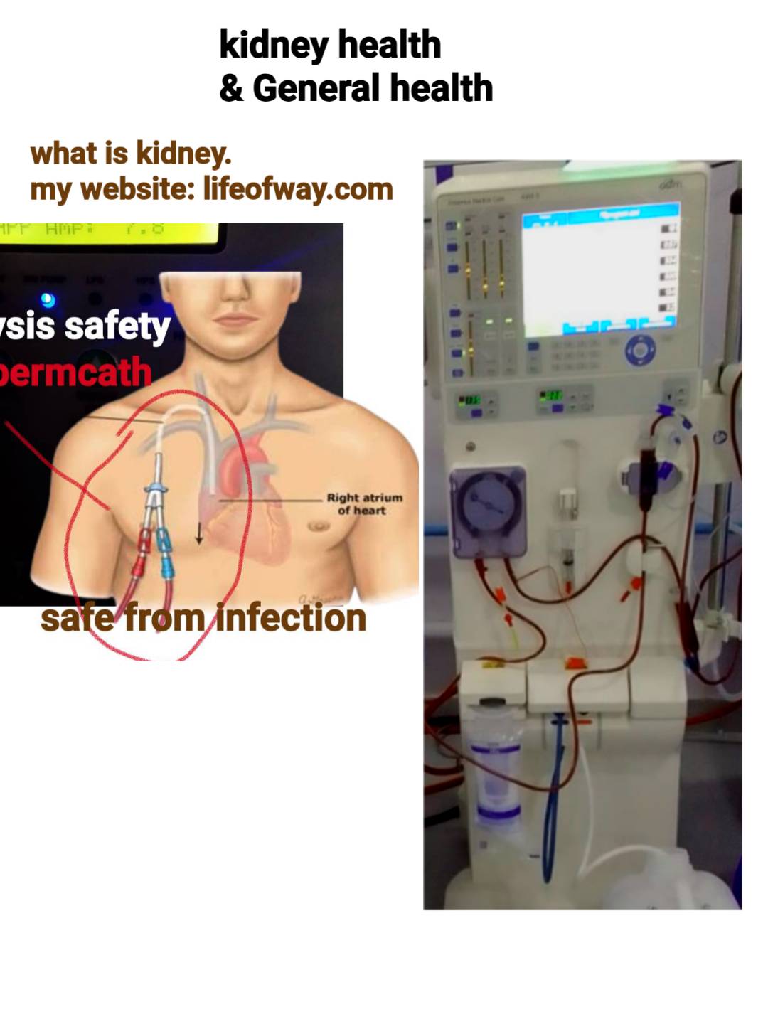 what is dialysis in public language