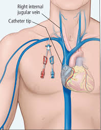 Catheter safety from infection during dialysis stage